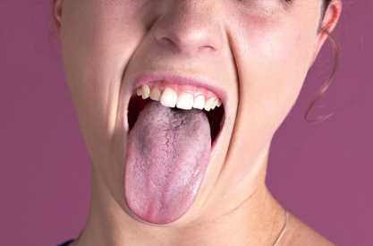 舌头烫起泡了能吃零食吗