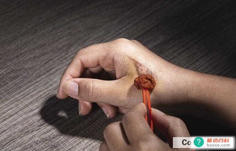 被烧伤后该怎么处理(被烧伤之后应该选择最正确的处理方法)