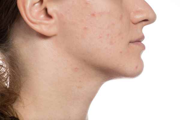 如何去粉刺印(白糖加热水搓揉后轻轻按摩粉刺印、将苹果用搅拌机搅成苹果泥敷在)