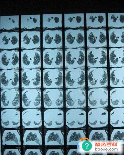 白肺是否对肺有不可逆伤害(白肺最严重的症状其实就是缺氧)