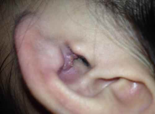 耳朵里面长了个痘痘是怎么回事(耳朵里面长痘痘要注意些什么)