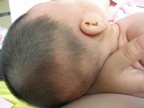 宝宝出现枕秃是因为缺钙吗(缺钙枕秃和正常枕秃图片)