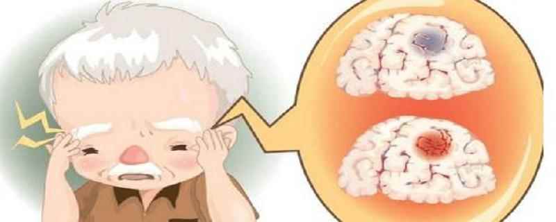 脑血管意外是怎么回事,脑血管意外有哪些疾病