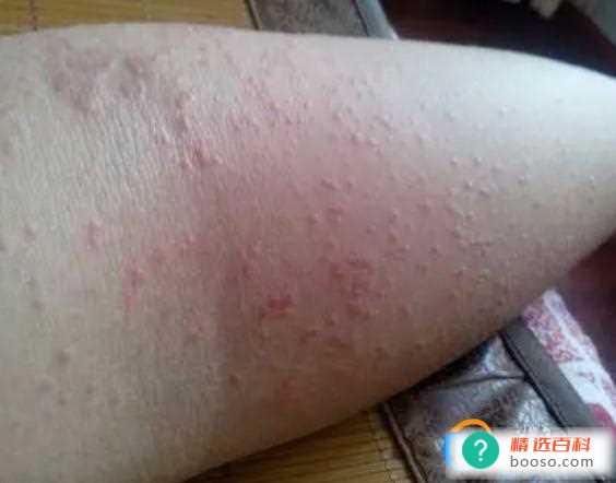 湿疹的人穿过的衣服还可以穿吗