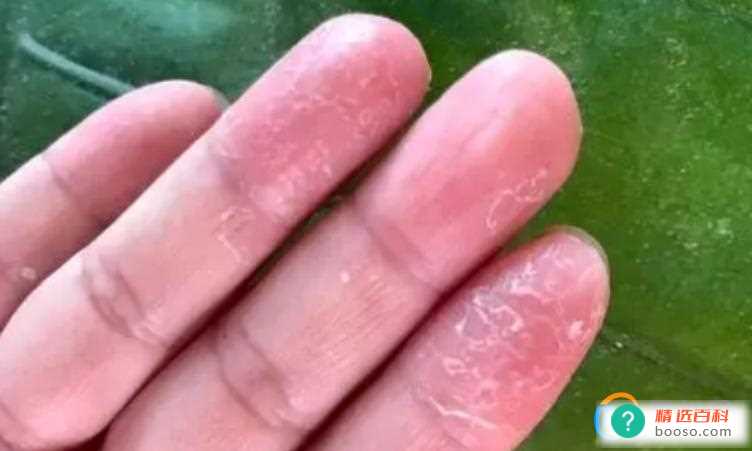 手蜕皮还痒的原因