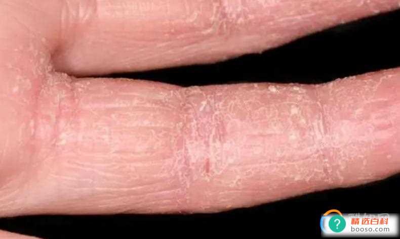 手蜕皮还痒的原因