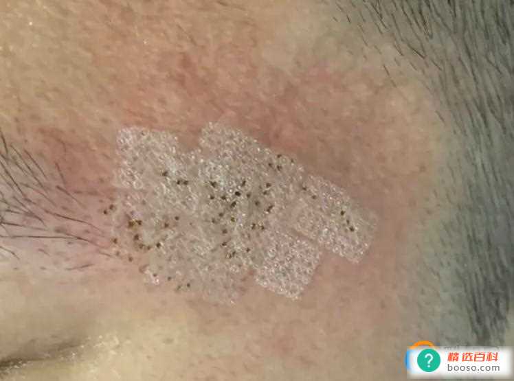 青春痘的治疗最佳方法有哪些