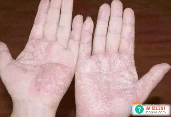 手脱皮是什么原因导致的