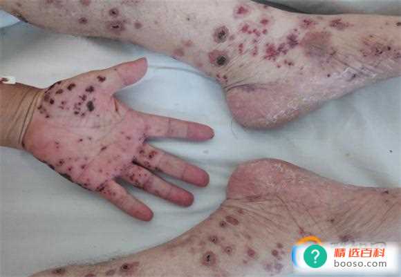 皮肤溃疡久不愈合的原因是什么