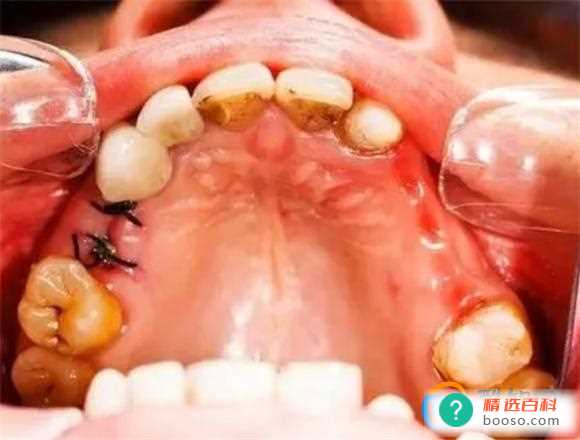 拔牙第3天为什么又疼的厉害了