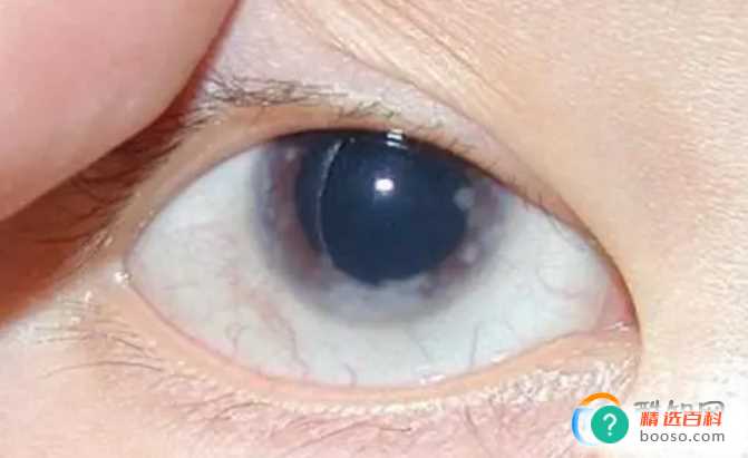 医学知识：青光眼是什么病？（一种致盲性的疾病）