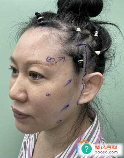 怎样去掉脸上的皱纹