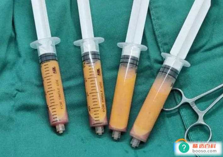 吸脂肪对身体有什么副作用(吸脂手术大概需要多少钱)