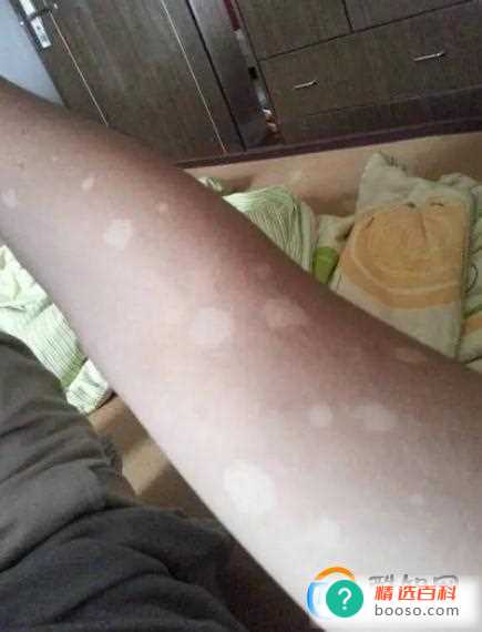 白斑怎么治才能根除(白癜风最新治疗方法)