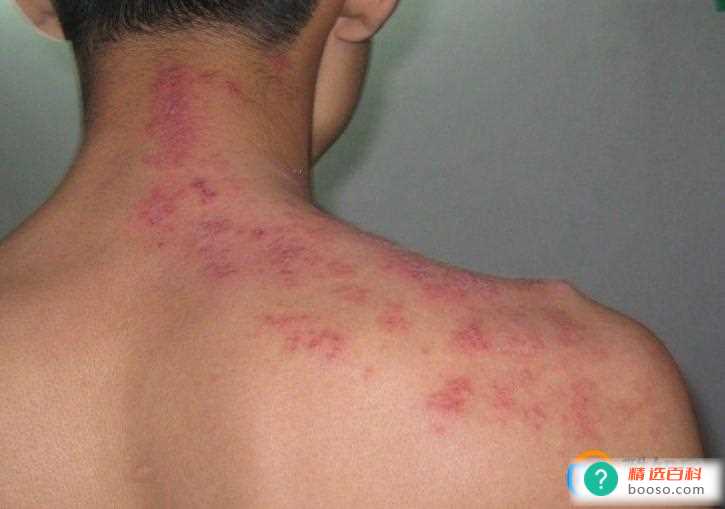 带状疱疹和皮炎的区别(皮炎和带状疱疹的区别)